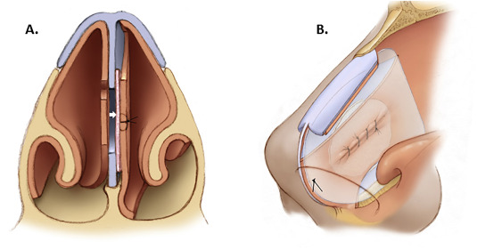 Reparatur einer Septumperforation