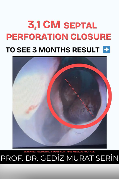 Septum Surgery Turkey Prof. Dr. Gediz Serin