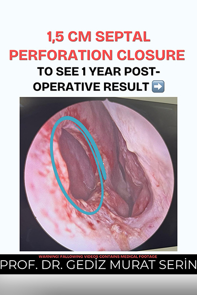 Septum Surgery Turkey Prof. Dr. Gediz Serin