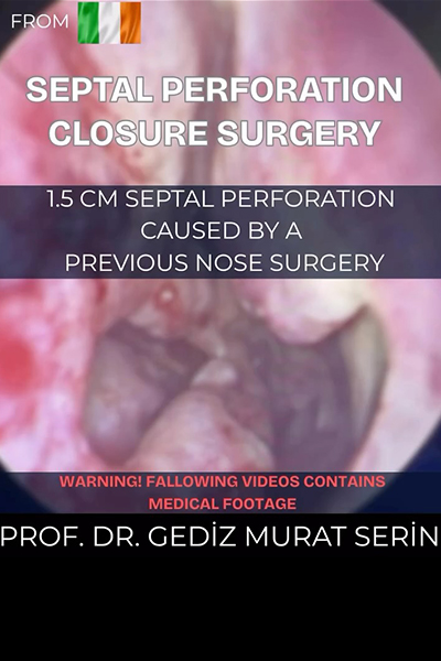 Septal Perforation Surgery Turkey Prof. Dr. Gediz Serin