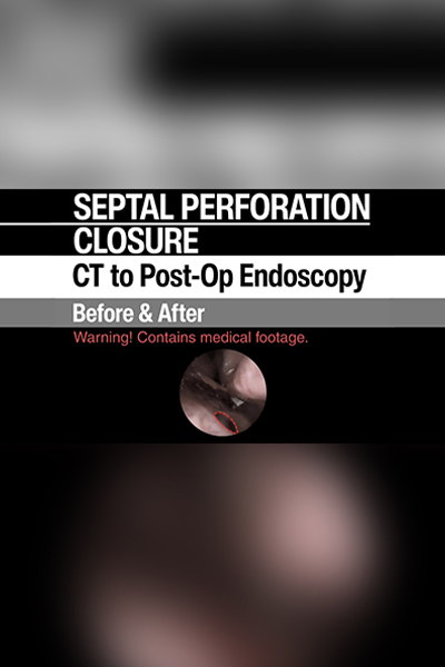 Septal Perforation Repair Turkey