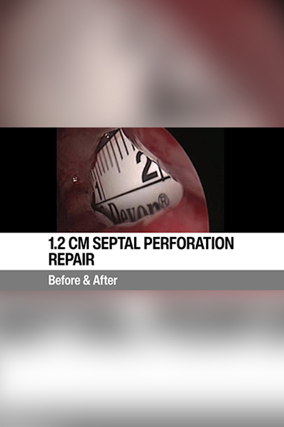 Septum Surgery Turkey Prof. Dr. Gediz Serin