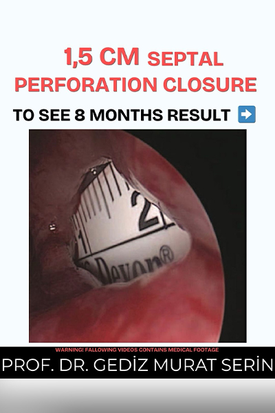 Septum Surgery Turkey Prof. Dr. Gediz Serin
