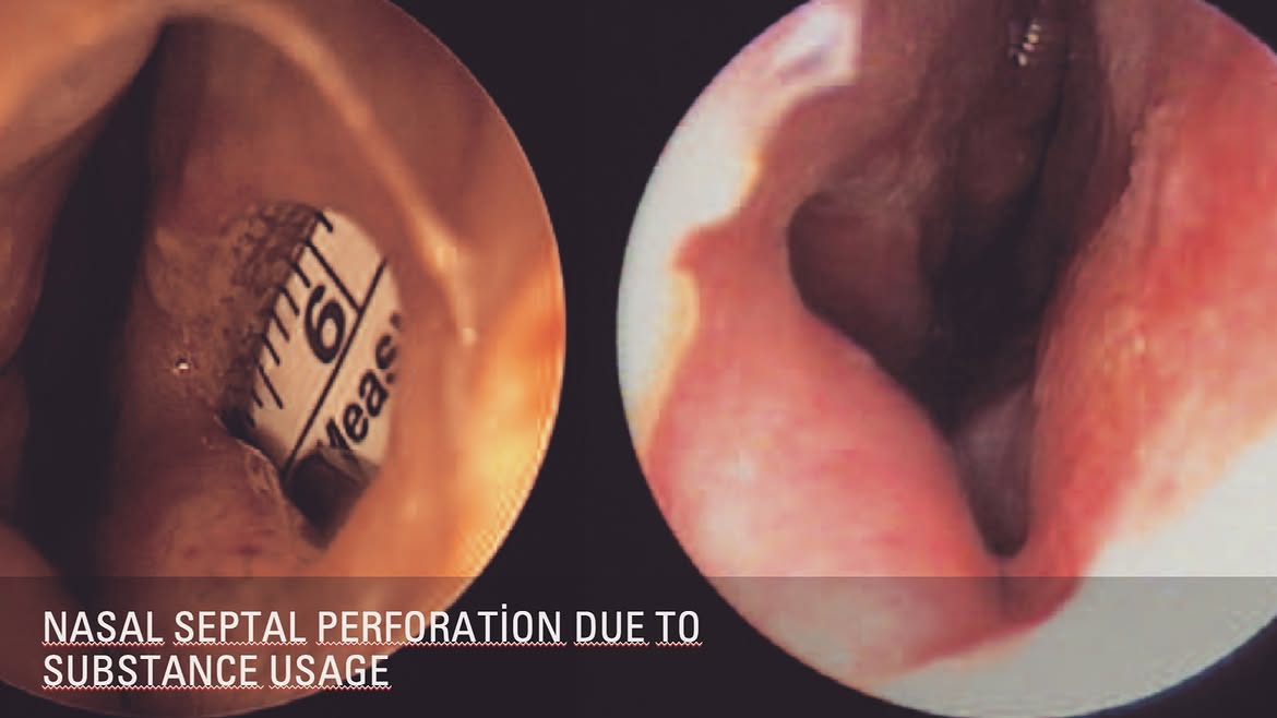 Septum Perforasyon Onarımı